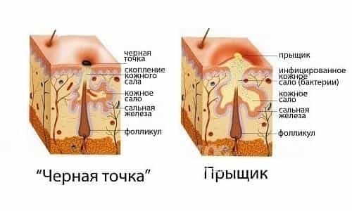 Образование угрей и прыщей