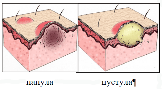 Папула и пустула чем отличаются