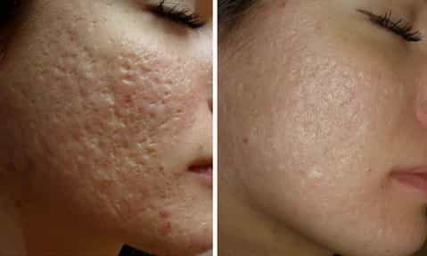 Шрамы на коже лица вызванные угрями и прыщами, до и после лечения