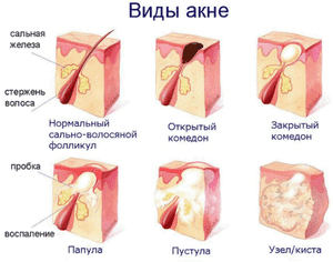 Виды акне