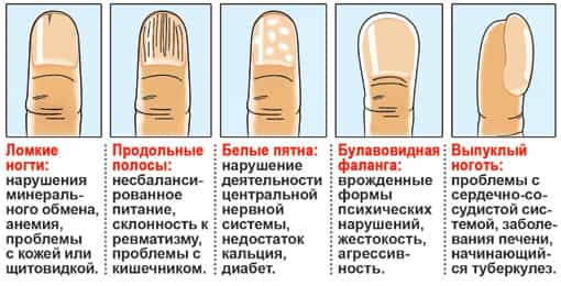 Каким болезням соответствует изменение формы ногтевых пластинок