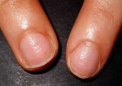 Атрофия ногтей