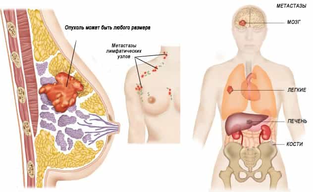 Опухоль молочной железы с метастазами