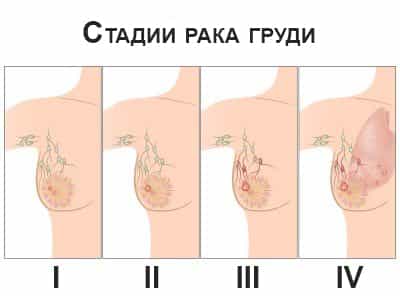 Стадии рака молочной железы