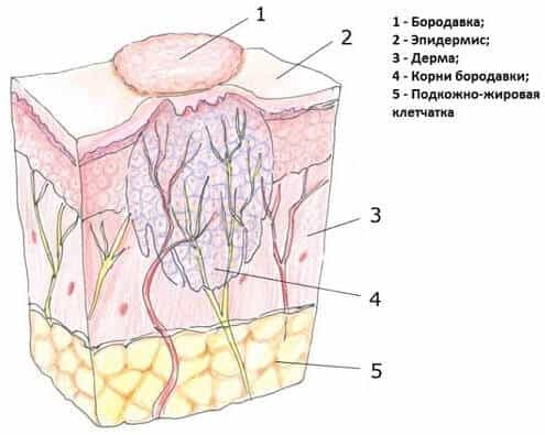Анатомия бородавки