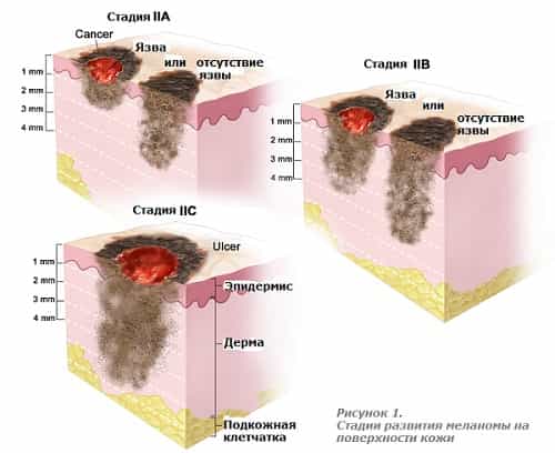 Стадии развития меланомы на поверхности кожи