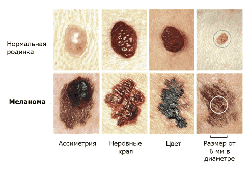 Сравнительное фото родинок и меланом