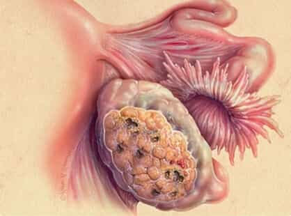 Злокачественная опухоль яичников