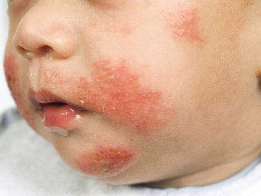 Аллергические болезни кожи