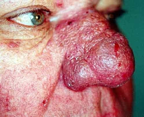 Инфекционные и паразитические заболевания кожи