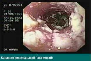 Висцеральный кандидоз
