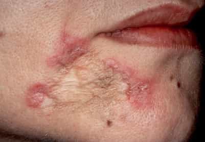 Туберкулез кожи