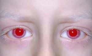 Альбинизм радужной оболочки глаз