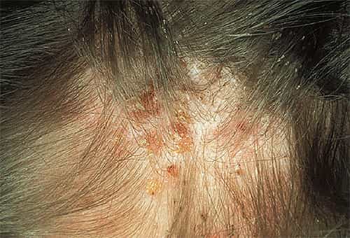 Симптомы педикулеза на волосистой части головы