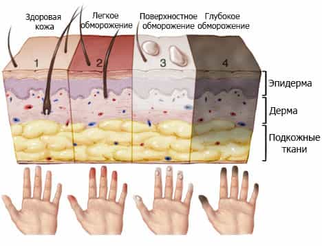 Выделяют четыре степени отморожения