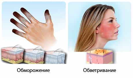 Различают четыре степени поражения холодом