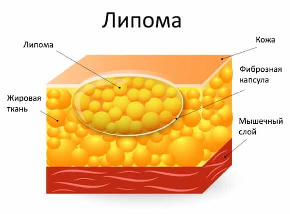 Анатомия липомы