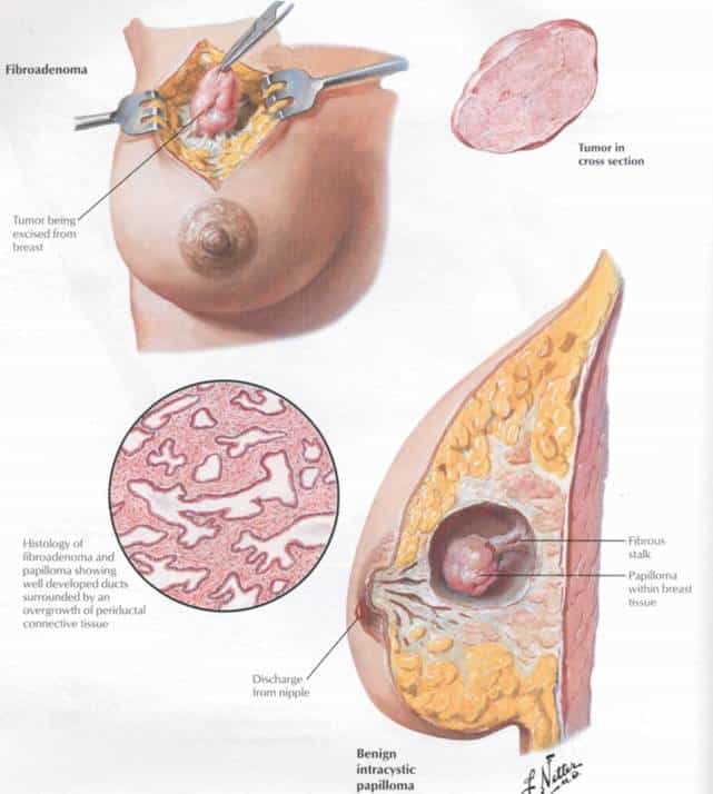 Фиброаденома молочной железы