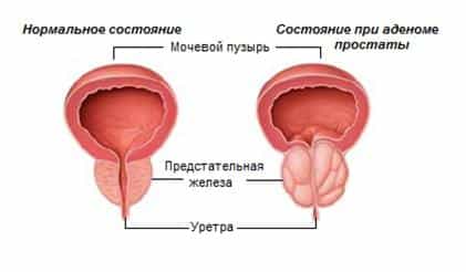 Фиброаденома простаты