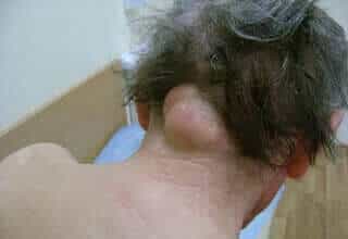 Атерома волосяной части головы