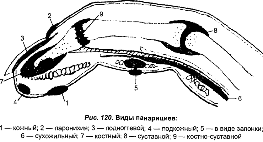 Виды панариция