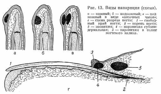 Виды панариция