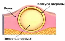 Киста сальных желез