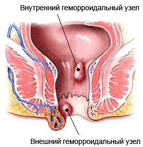 Геморрой