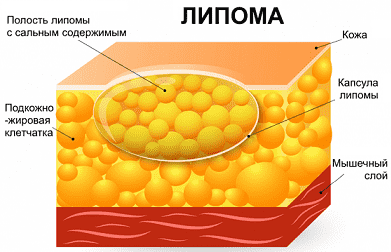 Лечение липомы