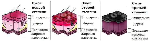 Симптомы ожогов