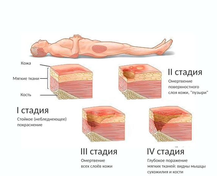 4 стадии развития пролежней