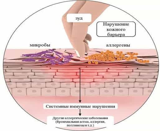 Атопический дерматит