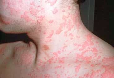 Аллергическая реакция на коже