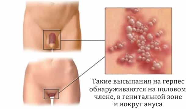 Места высыпания второго герпеса