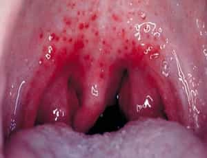 Герпес четвертого типа (вирус Эпштейн-Барр)-инфекционный монокулёз