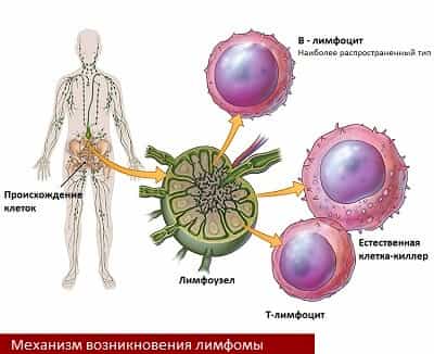 Механизм возникновения лимфомы