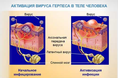 Образование герпетической сыпи