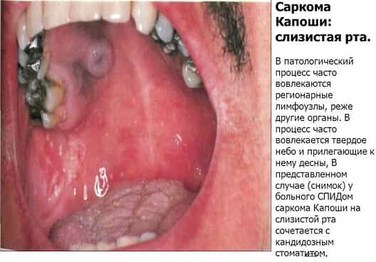 Саркома Капоши во рту