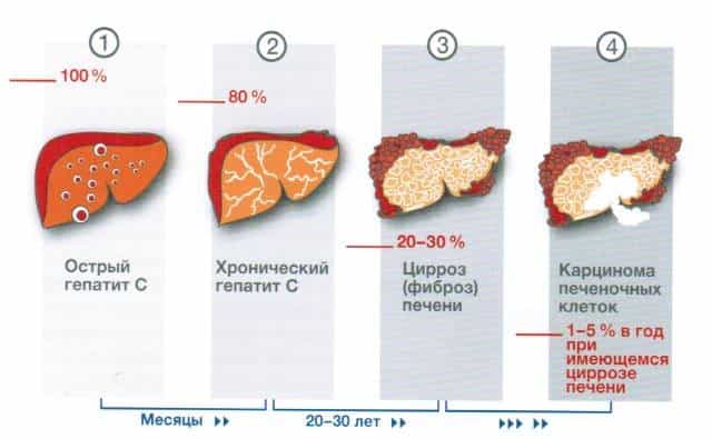 Этапы развития гепатита С в организме человека