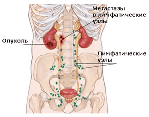 Распространение метастазов по лимфатическим узлам