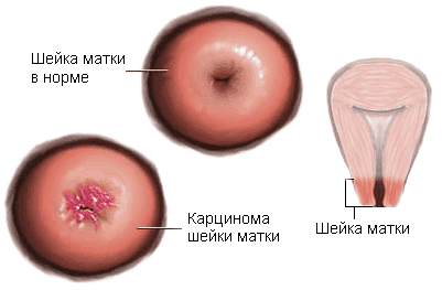 Карценома шейки матки