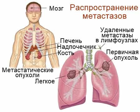 Распространение метастазов