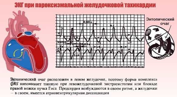 Пароксизмальная тахикардия