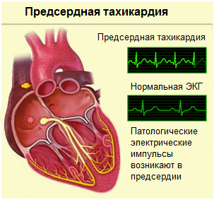 Предсердная тахикардия