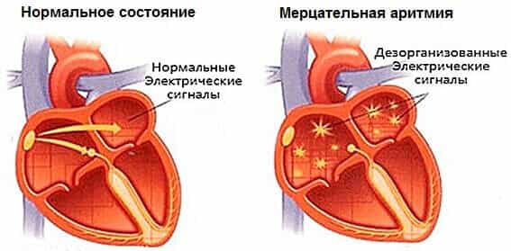 Мерцание и трепетание предсердий