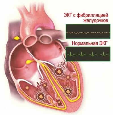 Мерцание и трепетание желудочков