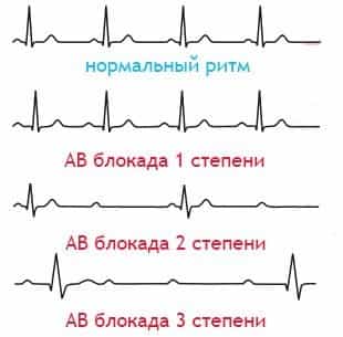 Степени блокады сердца