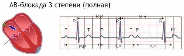 Симптомы блокады сердца