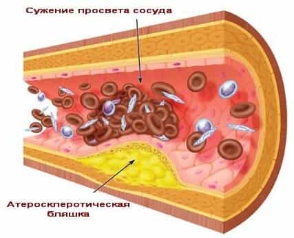 Атеросклероз