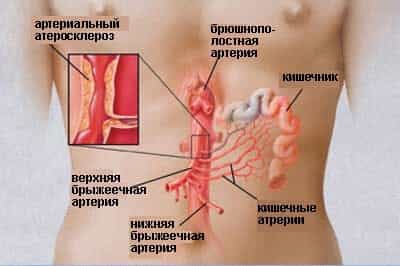 Атеросклероз брыжеечных артерий